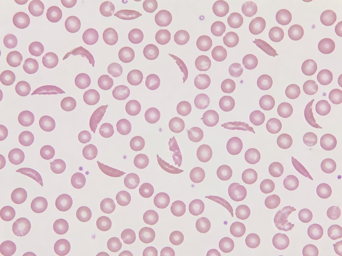 A blood smear from a person with sickle-cell disease: round red cells and, among them, the crescents. The cellular phenotype of a single amino acid substitution, carried on both alleles.