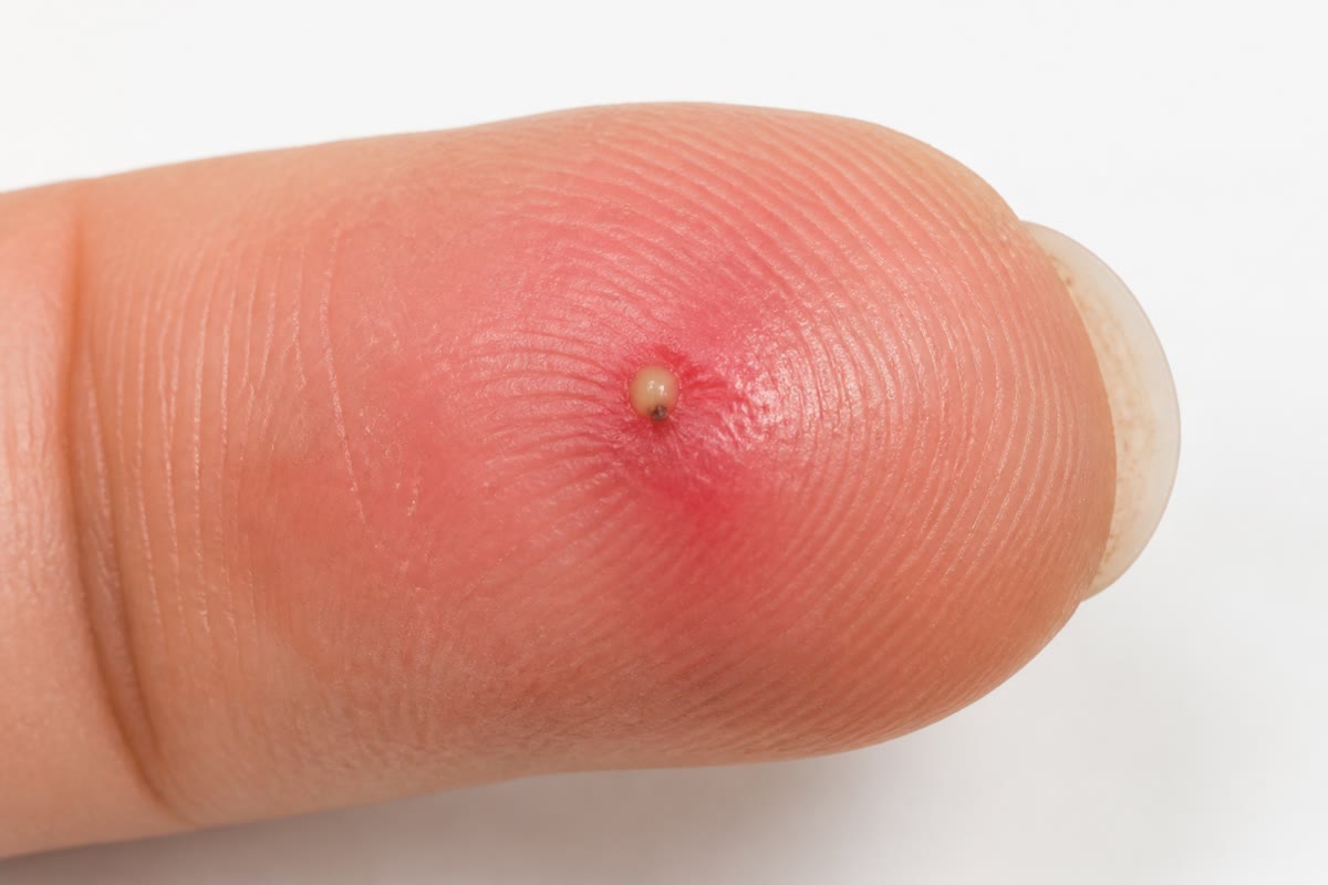 Una herida de astilla al día siguiente: roja, hinchada, dolorosa, con una gota de pus en el punto de entrada — la respuesta inflamatoria vista desde fuera. El pus son los fagocitos que vinieron, lucharon y murieron.